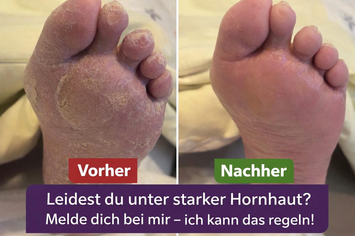 Vorher-Nachher: Fuß mit starker Hornhaut vor und nach der Behandlung
